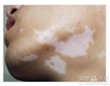 白癜风可以吃白瓜吗,白瓜的适宜与禁忌